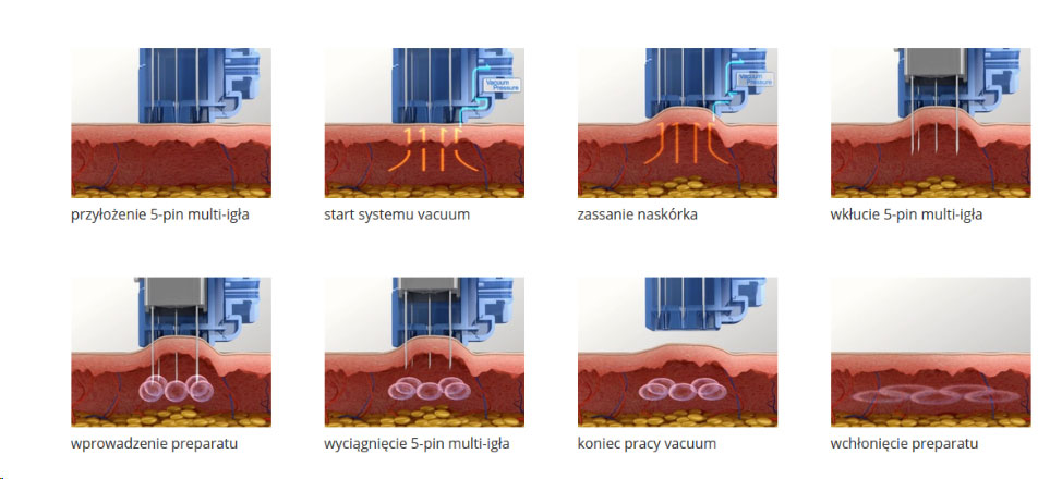 jak działa vital injector 2